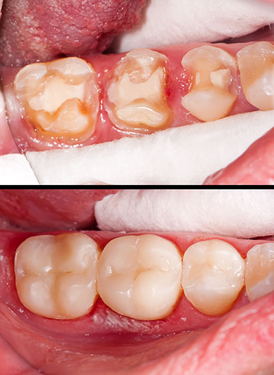 Holley Dental Care | Dentures, Sports Mouthguards and Preventative Program