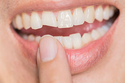 Holley Dental Care | Crowns  amp  Caps, Preventative Program and Dentures