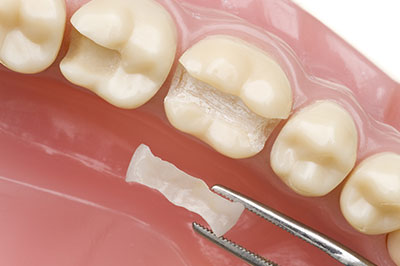 Holley Dental Care | Dental Bridges, Dental Fillings and Implant Restorations