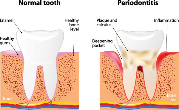 Holley Dental Care | Emergency Treatment, Oral Cancer Screening and Periodontal Treatment