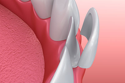 Holley Dental Care | Preventative Program, TMJ Disorders and Dentures