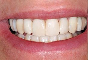 Holley Dental Care | Veneers, Dentures and Dental Cleanings
