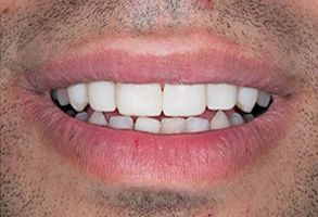 Holley Dental Care | Dental Cleanings, Cosmetic Dentistry and Implant Restorations