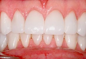 Holley Dental Care | Cosmetic Dentistry, Root Canals and Dentures