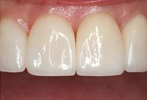 Holley Dental Care | Sedation Dentistry, Crowns  amp  Caps and VELscope reg  Cancer Screening