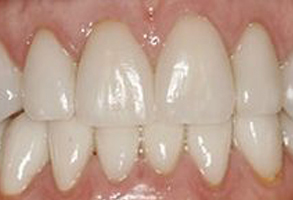 Holley Dental Care | Preventative Program, Cosmetic Dentistry and TMJ Disorders
