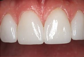 Holley Dental Care | Implant Restorations, Periodontal Treatment and Sports Mouthguards