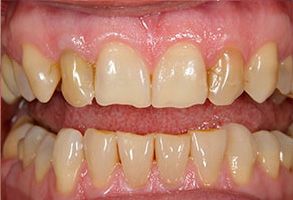 Holley Dental Care | Invisalign reg , Oral Exams and TMJ Disorders