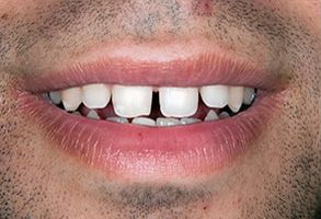 Holley Dental Care | Crowns  amp  Caps, Dentures and Cosmetic Dentistry