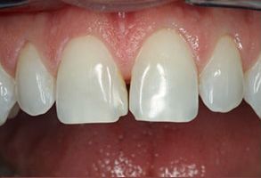 Holley Dental Care | Extractions, TMJ Disorders and Night Guards